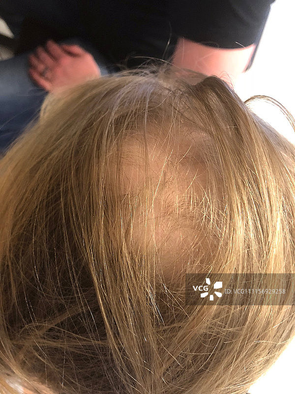 美国:9岁女孩患脱发症剃光头 正能量满满带发